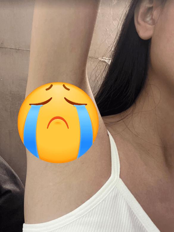 청주겨드랑이레이저제모 어디서들 하시나요? 1