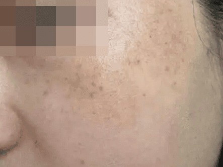 여수기미제거 레이저토닝 잘하는 곳 1