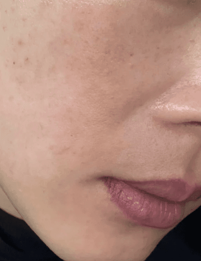 여수기미제거 레이저토닝 어디가 잘해요? 1