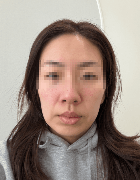 대구 윤곽관리 올타이트 리프팅 불독살과 이별한 후기 1