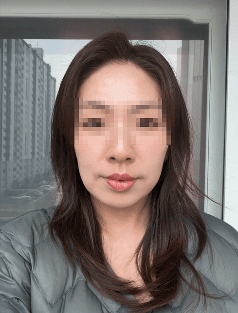 대구 윤곽관리 올타이트 리프팅 불독살과 이별한 후기 2