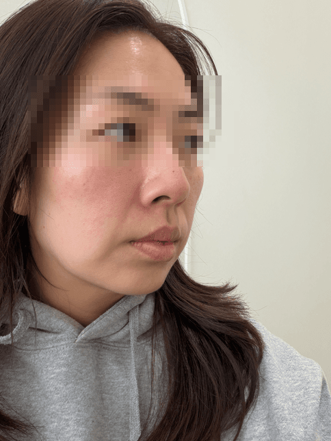 대구 윤곽관리 올타이트 리프팅 불독살과 이별한 후기 3