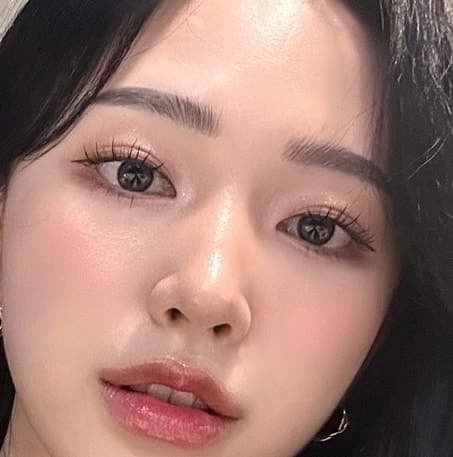 이마지방이식 관자놀이, 눈밑 포함한 얼굴지방이식후기 전체 80만원대로 가능 2