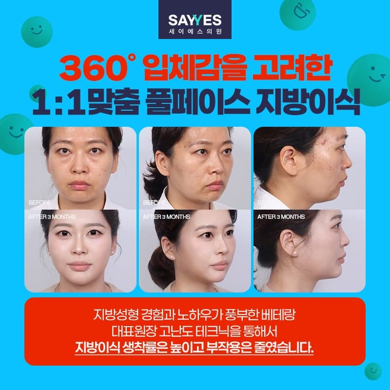 이마지방이식 관자놀이, 눈밑 포함한 얼굴지방이식후기 전체 80만원대로 가능 7