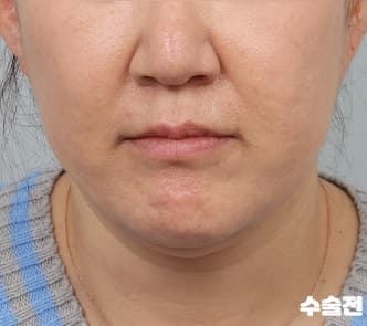 턱라인리프팅 브이라인 안면거상술비용 낮춘 미니거상가격 2