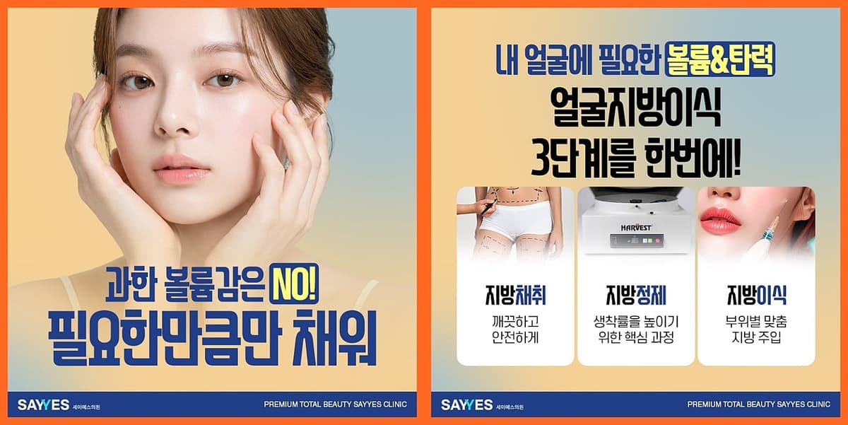 풀페이스지방이식 유지기간 이마자가지방이식 가격 포함 89만원임 3