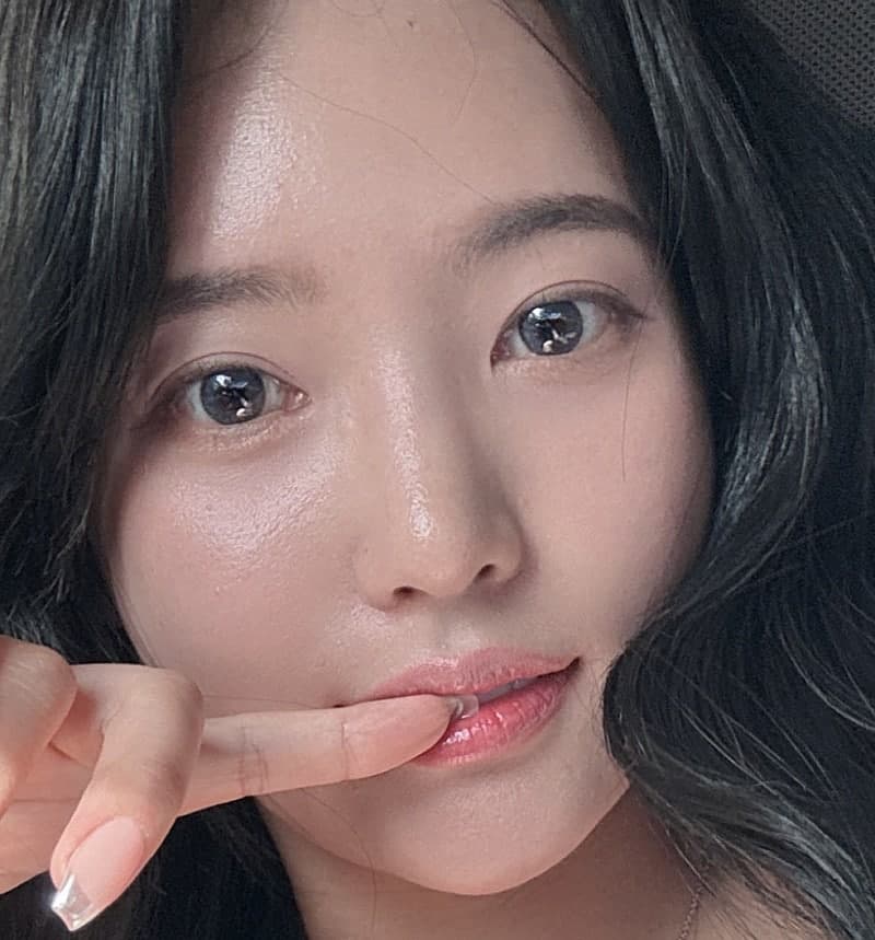 풀페이스지방이식 유지기간 이마자가지방이식 가격 포함 89만원임 4