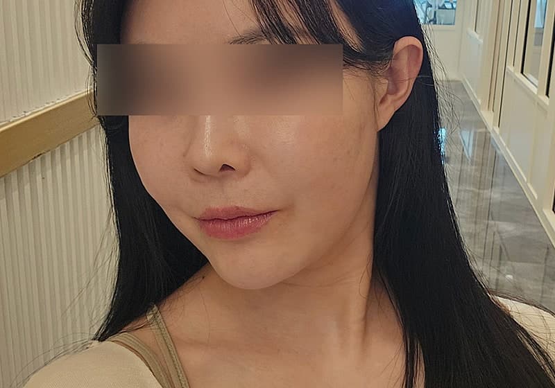 대전 울쎄라 후기!! 리즈시절 피부됨ㅋㅋ 3