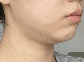 순천울쎄라 잘하는 곳 알려주세요 1