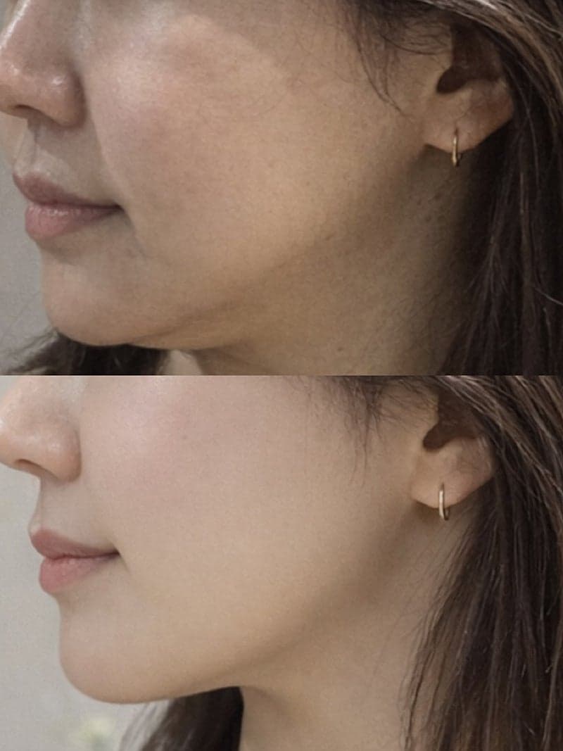 울산온다리프팅 윤곽주사 조합 후기 (이중턱) 1
