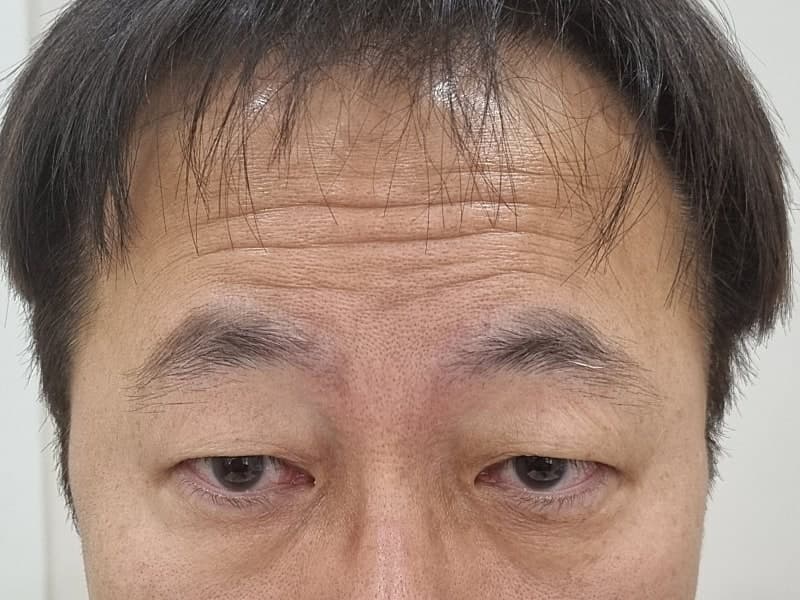 아버지 지인추천 받고 ㅁㄹ에서 효도성형해드리고 왔습니다. (중년눈수술) 1