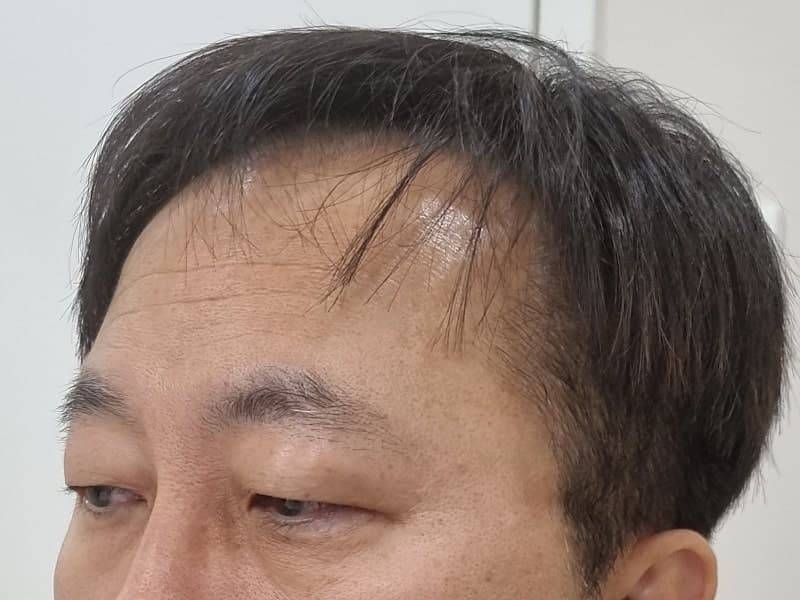 아버지 지인추천 받고 ㅁㄹ에서 효도성형해드리고 왔습니다. (중년눈수술) 2