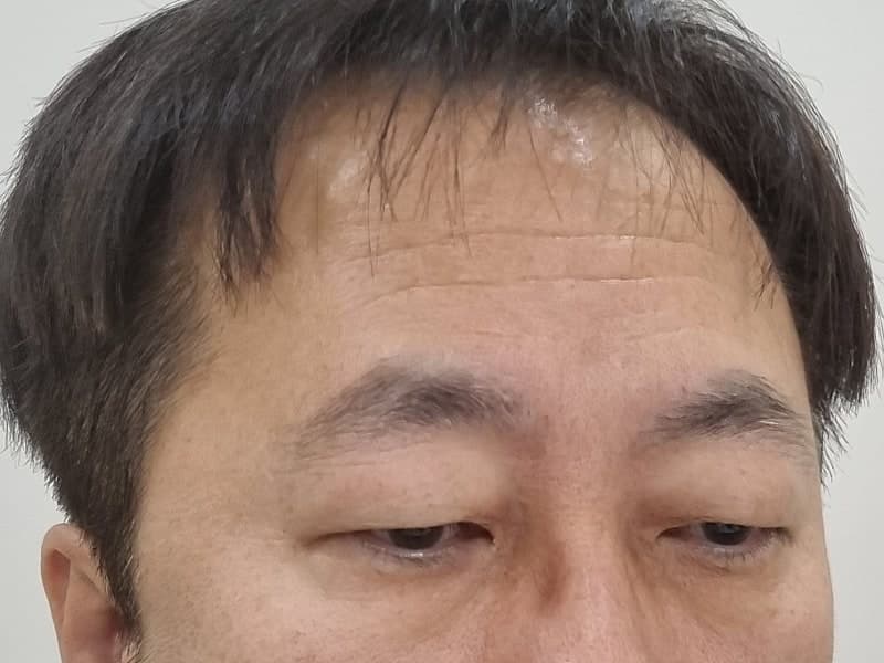 아버지 지인추천 받고 ㅁㄹ에서 효도성형해드리고 왔습니다. (중년눈수술) 3