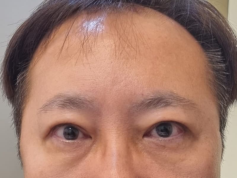 아버지 지인추천 받고 ㅁㄹ에서 효도성형해드리고 왔습니다. (중년눈수술) 4