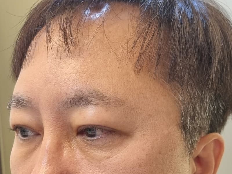 아버지 지인추천 받고 ㅁㄹ에서 효도성형해드리고 왔습니다. (중년눈수술) 5