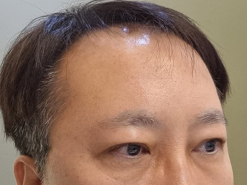 아버지 지인추천 받고 ㅁㄹ에서 효도성형해드리고 왔습니다. (중년눈수술) 6