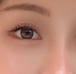 눈썹하거상 수술 후기 비용 70만원 전후 1