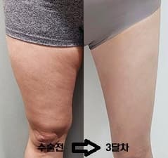 허벅지지방흡입후기 지방추출주사 비용? 1