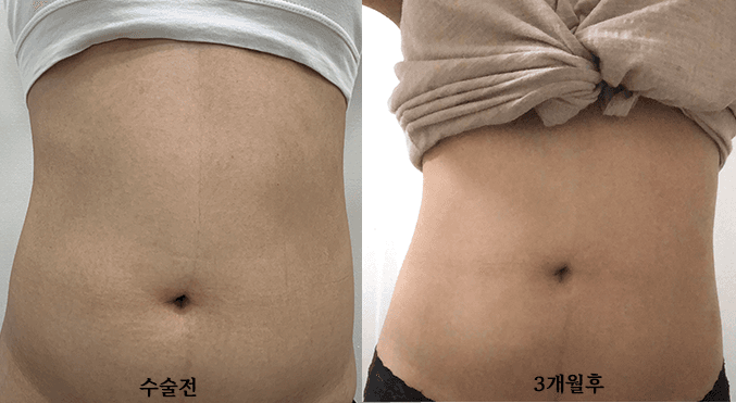 복부지방흡입 가격 대용량전체 얼마? 2