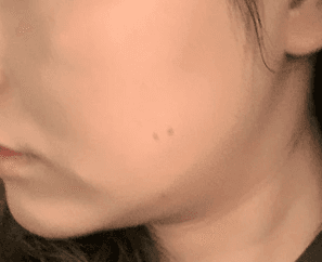 청주온다리프팅 어디가 잘해요? 1