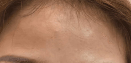 여수필러 어디가 잘하나요? 1