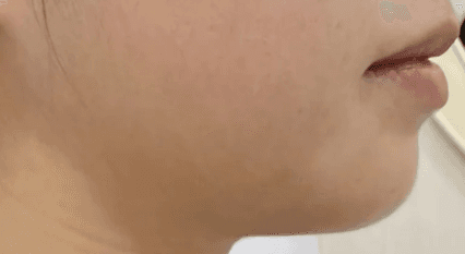 여수보톡스 잘하는 곳 추천좀요 ㅠ 1