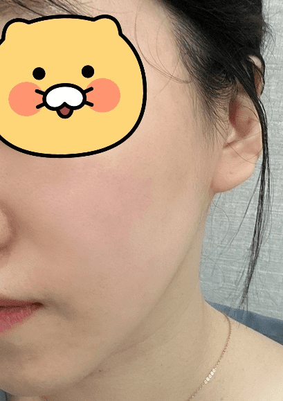 강동피부과 리프팅 이중턱 효과보는중 1
