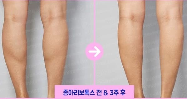 종아리보톡스효과 본 후기! 1