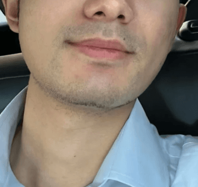 안산수염제모 잘하는 곳 추천부탁드립니다 1