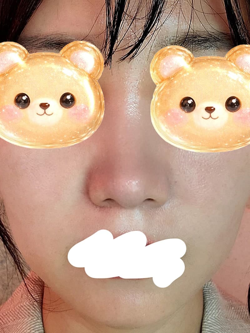 ㅍㄴㅅ 성형외과 자가늑으로 코수술했는데 3