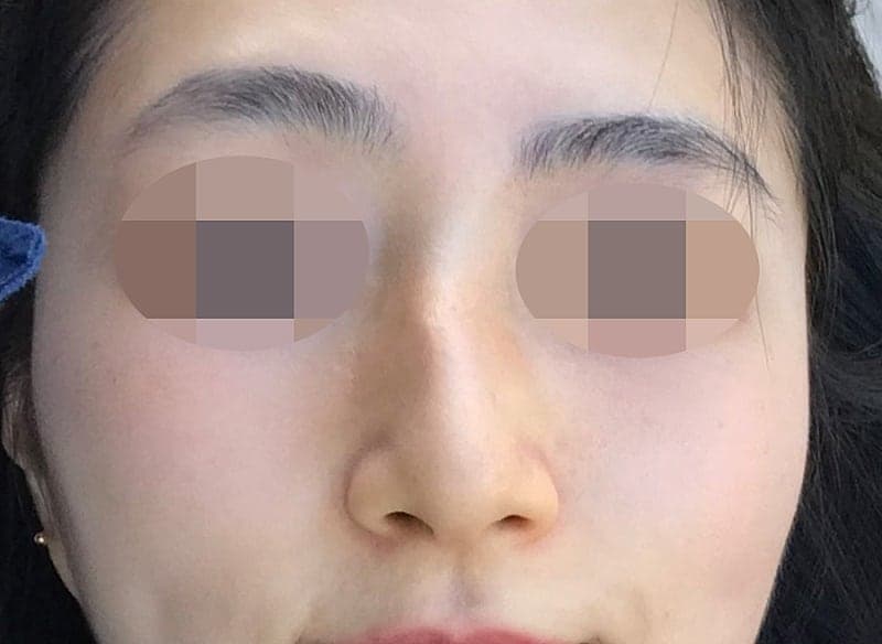 진짜 심각했던 휜코+매부리코 다 잡은 솔직 후기…ㅇㅂㅈ성형외과 1