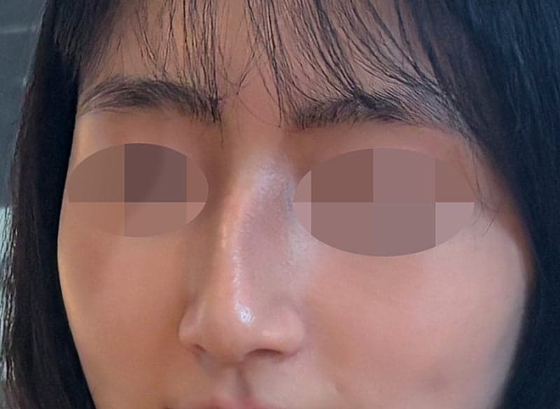 진짜 심각했던 휜코+매부리코 다 잡은 솔직 후기…ㅇㅂㅈ성형외과 2