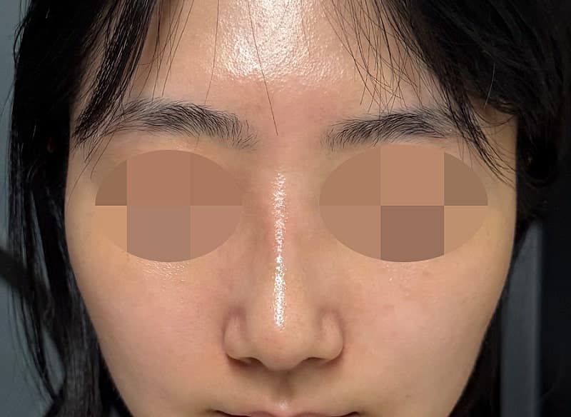 진짜 심각했던 휜코+매부리코 다 잡은 솔직 후기…ㅇㅂㅈ성형외과 3