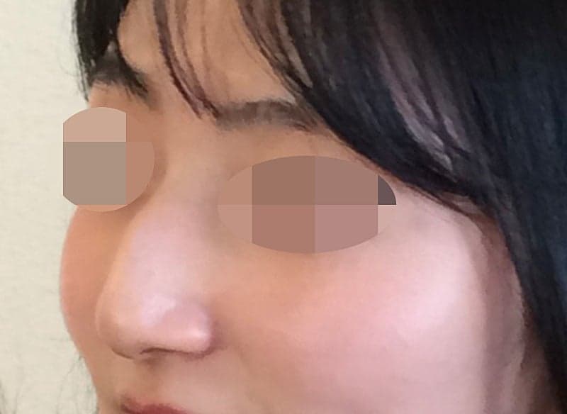 진짜 심각했던 휜코+매부리코 다 잡은 솔직 후기…ㅇㅂㅈ성형외과 5