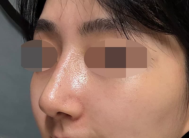 진짜 심각했던 휜코+매부리코 다 잡은 솔직 후기…ㅇㅂㅈ성형외과 6