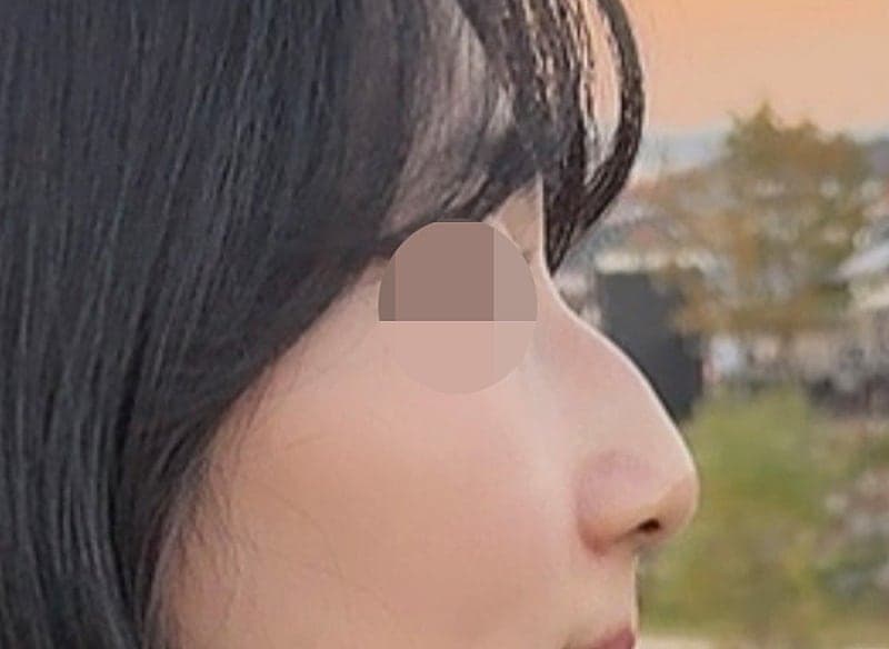 진짜 심각했던 휜코+매부리코 다 잡은 솔직 후기…ㅇㅂㅈ성형외과 7