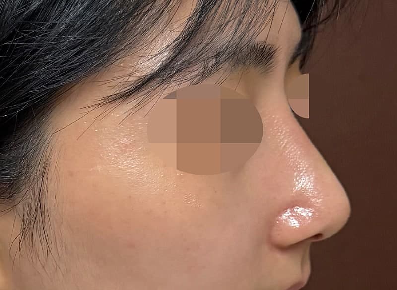 진짜 심각했던 휜코+매부리코 다 잡은 솔직 후기…ㅇㅂㅈ성형외과 8