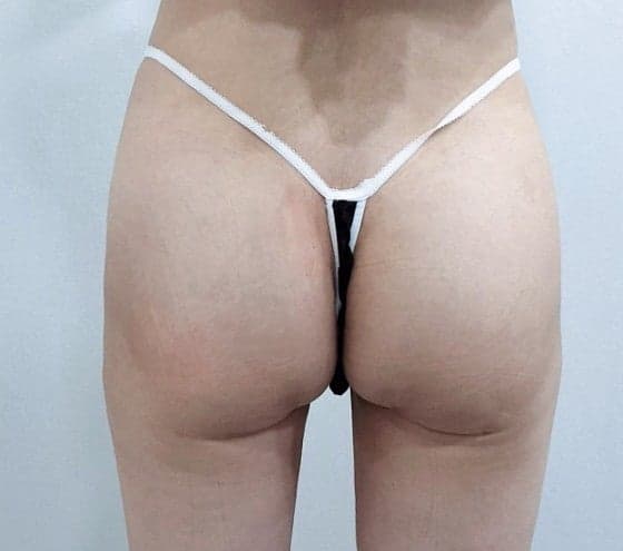 엉덩이필러 맞고 뒤태 인생 바뀜… 청바지 핏 미쳤어요ㅋㅋ (청담 큐비큐 bb) 1