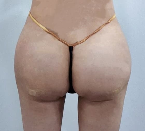 엉덩이필러 맞고 뒤태 인생 바뀜… 청바지 핏 미쳤어요ㅋㅋ (청담 큐비큐 bb) 2