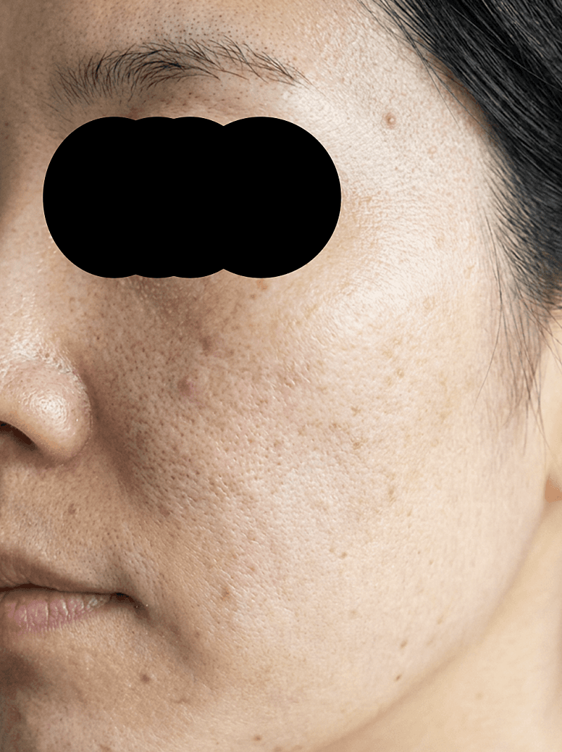 성수동 피부과 여드름 때문에 다녀온 후기! 1