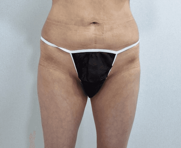큐비큐 골반필러후기 대방출!!🥰 1