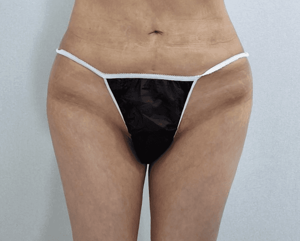 큐비큐 골반필러후기 대방출!!🥰 2