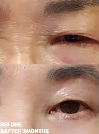 눈썹하거상술 만족 후기! 2