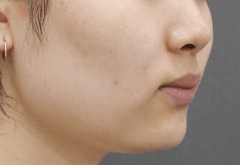 라포엘의원 실리프팅 진짜 돈값 하네요 ㅋㅋ 라인 정리 대박임 3