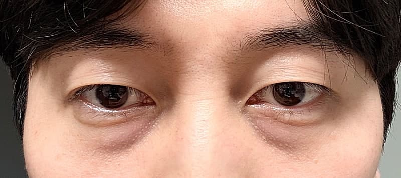 남자 눈밑지 오브제 박시현 원장님 추천 리뷰 1