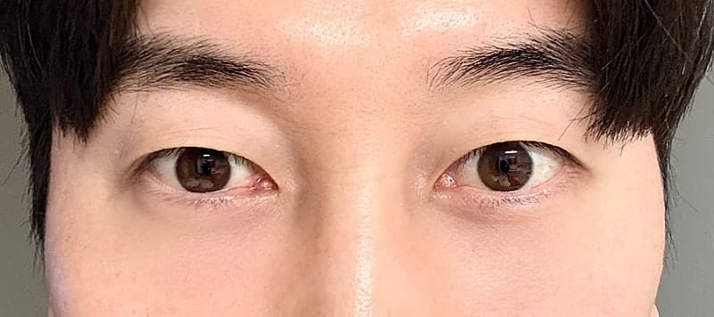 남자 눈밑지 오브제 박시현 원장님 추천 리뷰 2