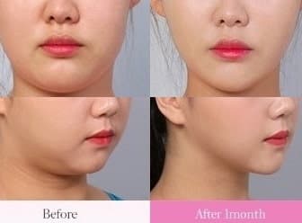 얼굴지방흡입 한달차 후기! 1