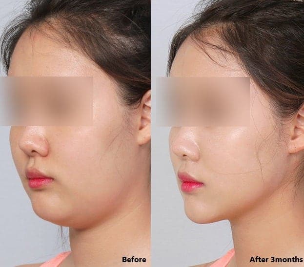 이중턱지방흡입비용 심부볼제거 60만원대가능? 1