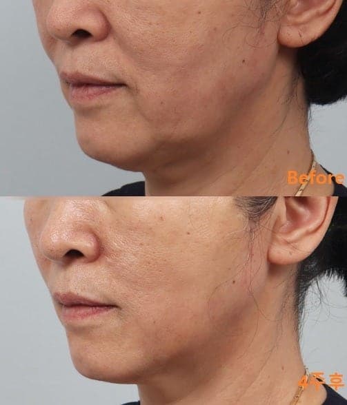 안면거상술가격 100만원대로 가능!? 1