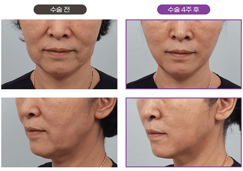 안면거상술가격 100만원대로 가능!? 2